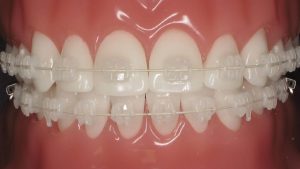 Ceramic Braces